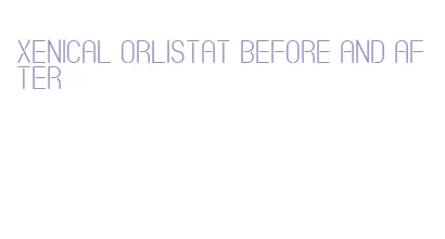 xenical orlistat before and after