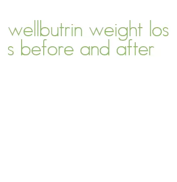 wellbutrin weight loss before and after