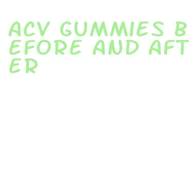 acv gummies before and after