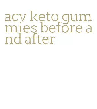 acv keto gummies before and after