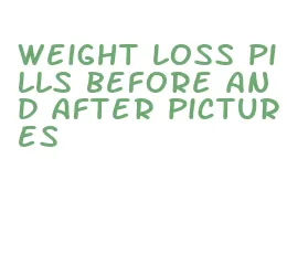 weight loss pills before and after pictures